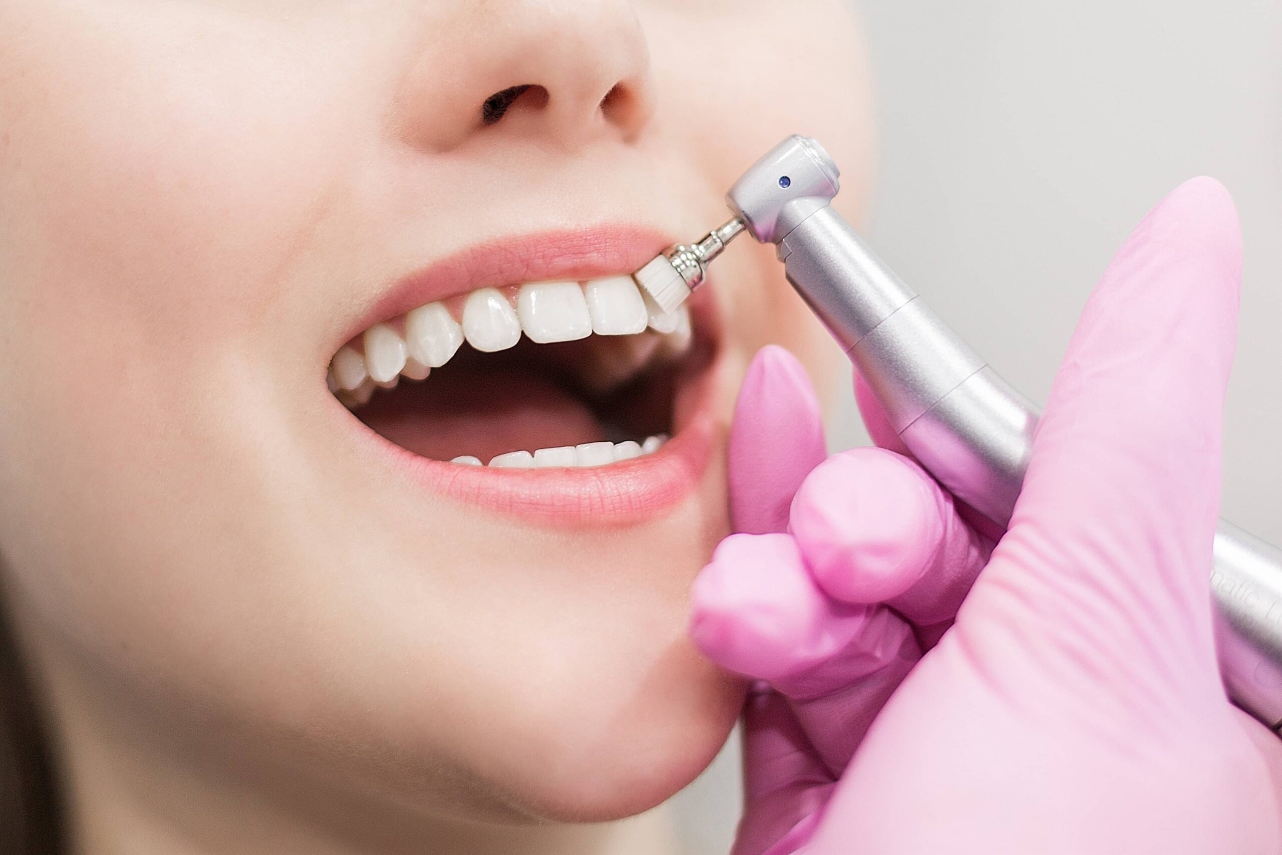 Best Teeth Whitening Treatment in Whitefield