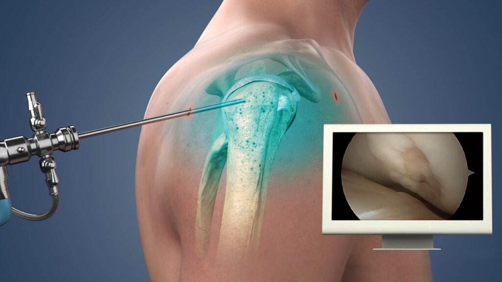 shoulder surgery