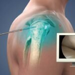 shoulder surgery