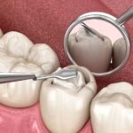 dental filling