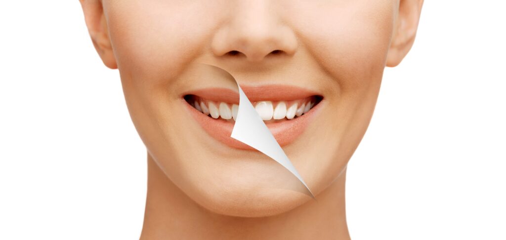 Smile Makeover