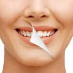 Smile Makeover