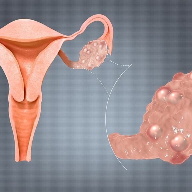 960px-Polycystic_Ovaries