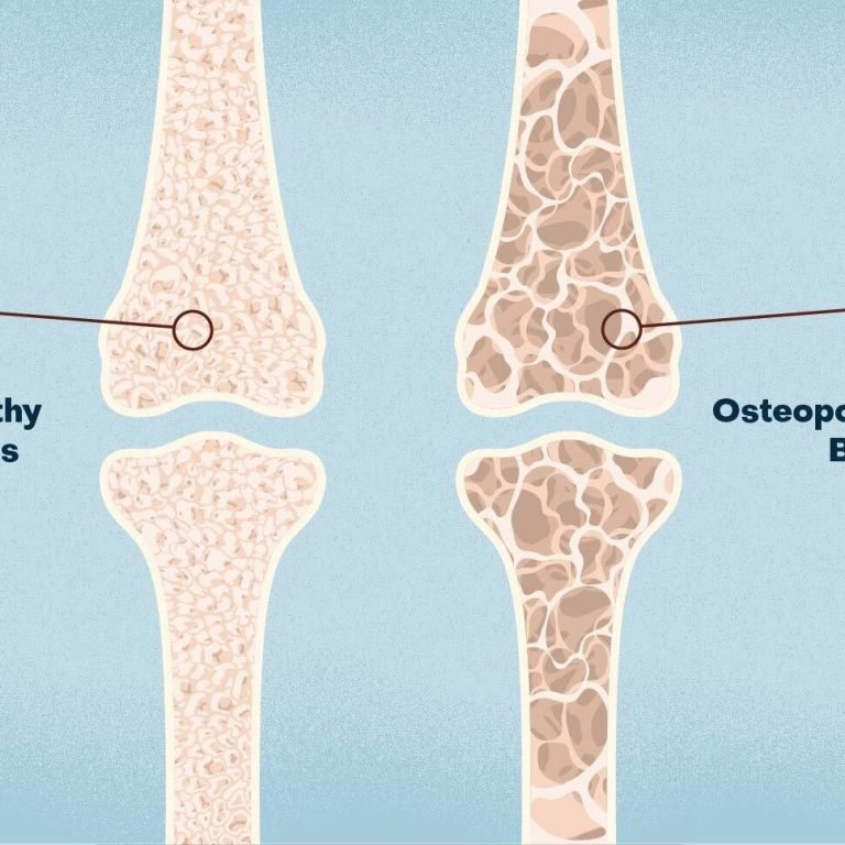 Osteoporosis-new