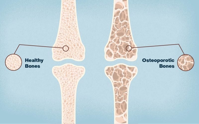 Osteoporosis-new