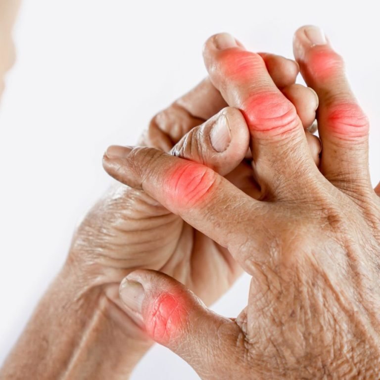 Rheumatoid_Arthritis_Joint_Pain_f716ef1d44