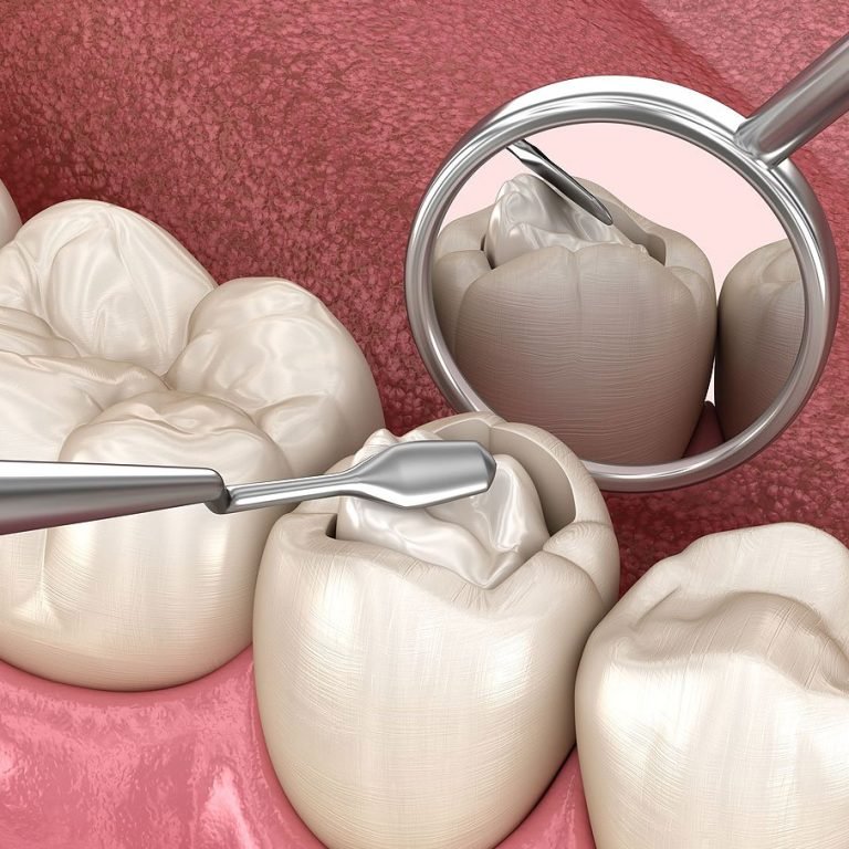 dental filling