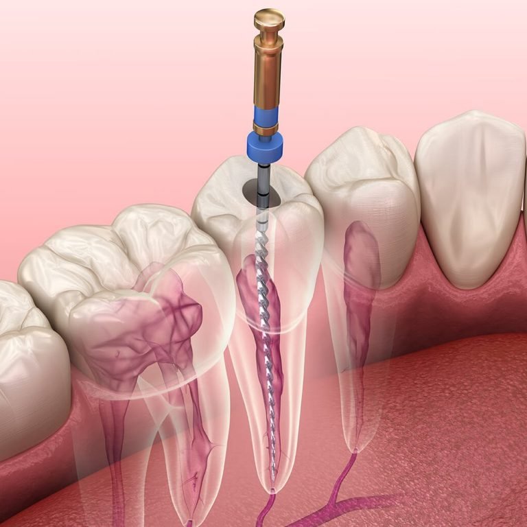 root-canal-infection-symptoms-tucson-az