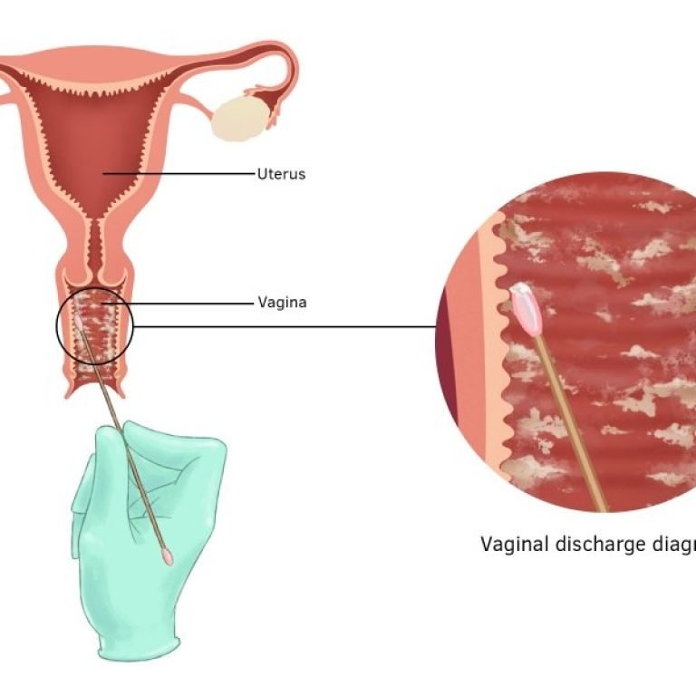 vaginal-discharge