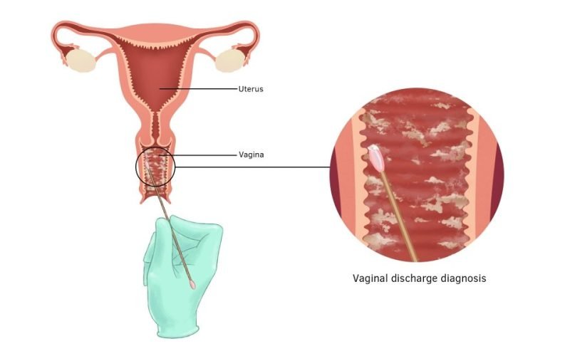 vaginal-discharge